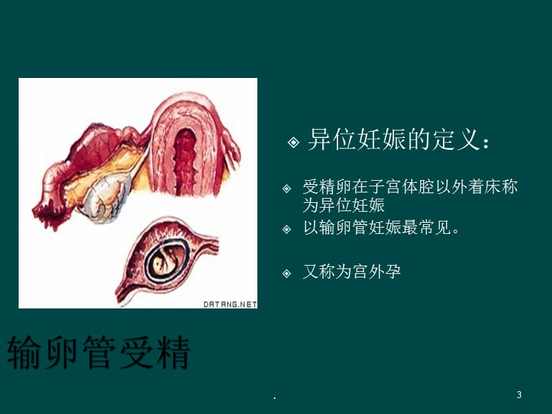 武汉供卵代怀服务_(哪个靠谱)1l异位妊娠主要护理问题-第1张图片-依高网